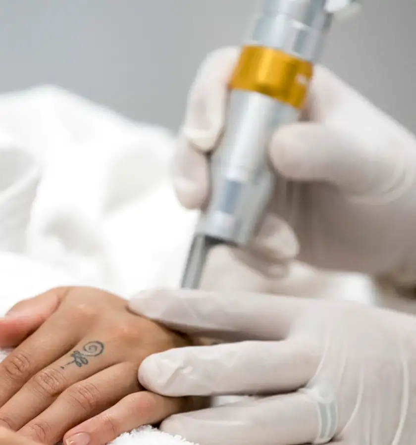 Détatouage laser picoseconde à Nice - Efficace tous pigments et phototypes