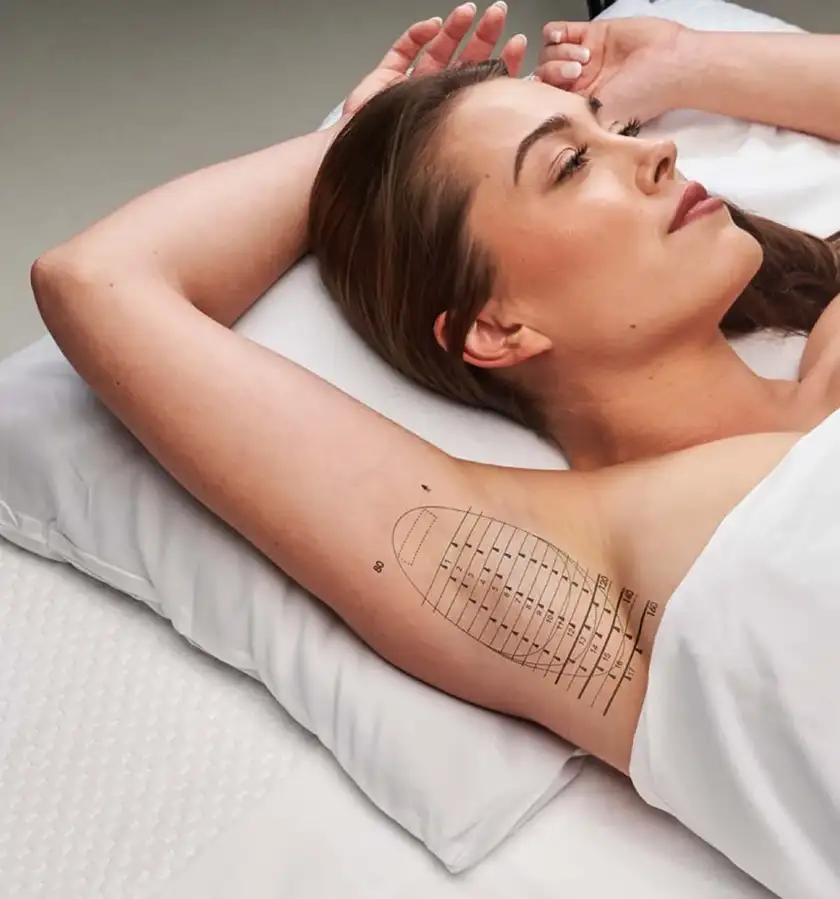 Traitement miraDry contre la sudation excessive à Nice - Clinique de la Peau