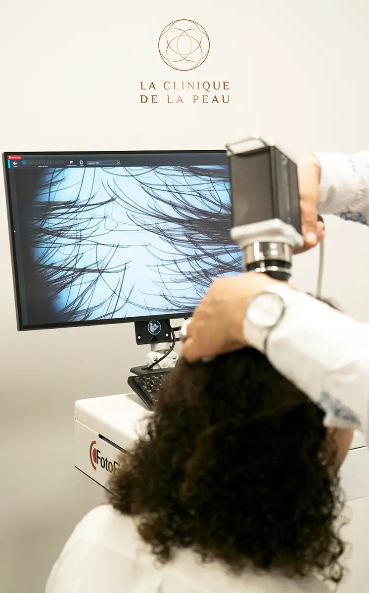Diagnostic de la chute de cheveux par trichoscopie numérique : examen approfondi du cuir chevelu par un spécialiste.