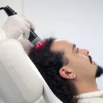 Diagnostic et solutions pour la chute de cheveux : consultation à la clinique de la peau Nice.