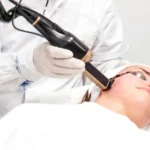 Dermatologue de la Clinique de la Peau soignant les rougeurs du visage d'une patiente avec le laser vasculaire Derma-V.