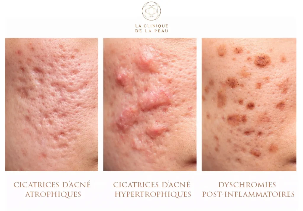 Illustration médicale montrant les différents types de cicatrices d'acné : atrophiques (ice-pick, boxcar, rolling), hypertrophiques et marques pigmentaires.