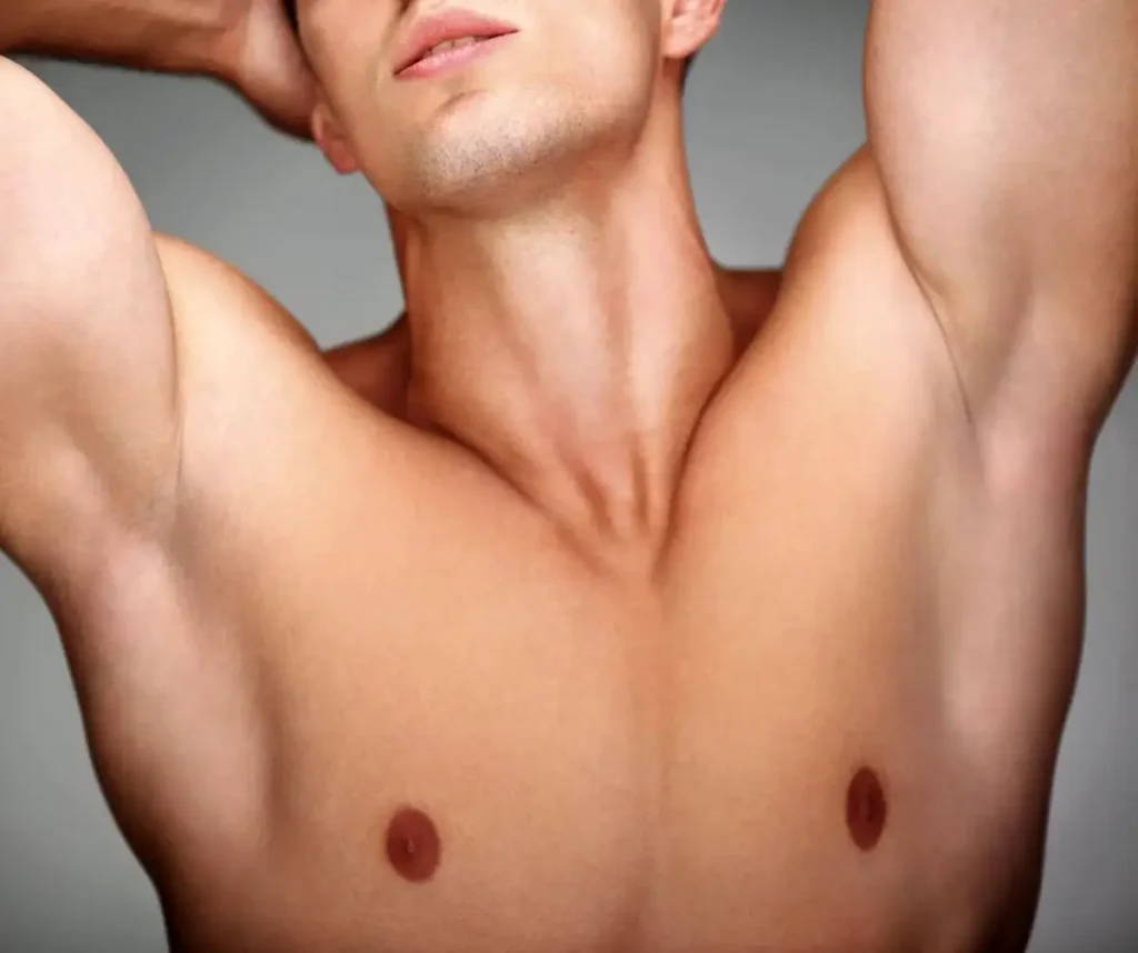 Résultat après traitement de l'hyperhidrose axillaire à la Clinique de la Peau Nice.