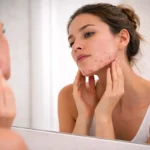 Une femme observant les signes de l'acné femme adulte dans son miroir, illustrant le besoin de soins dermatologiques.