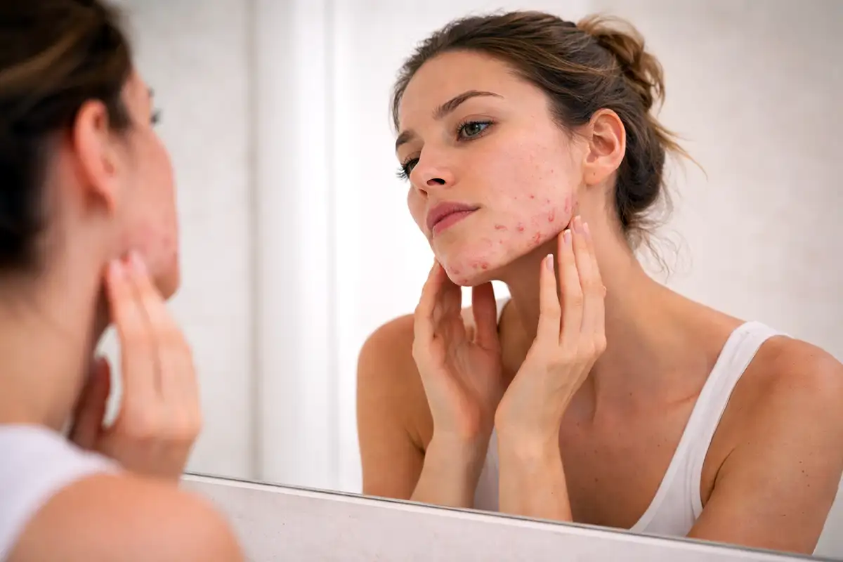 Une femme observant les signes de l'acné femme adulte dans son miroir, illustrant le besoin de soins dermatologiques.