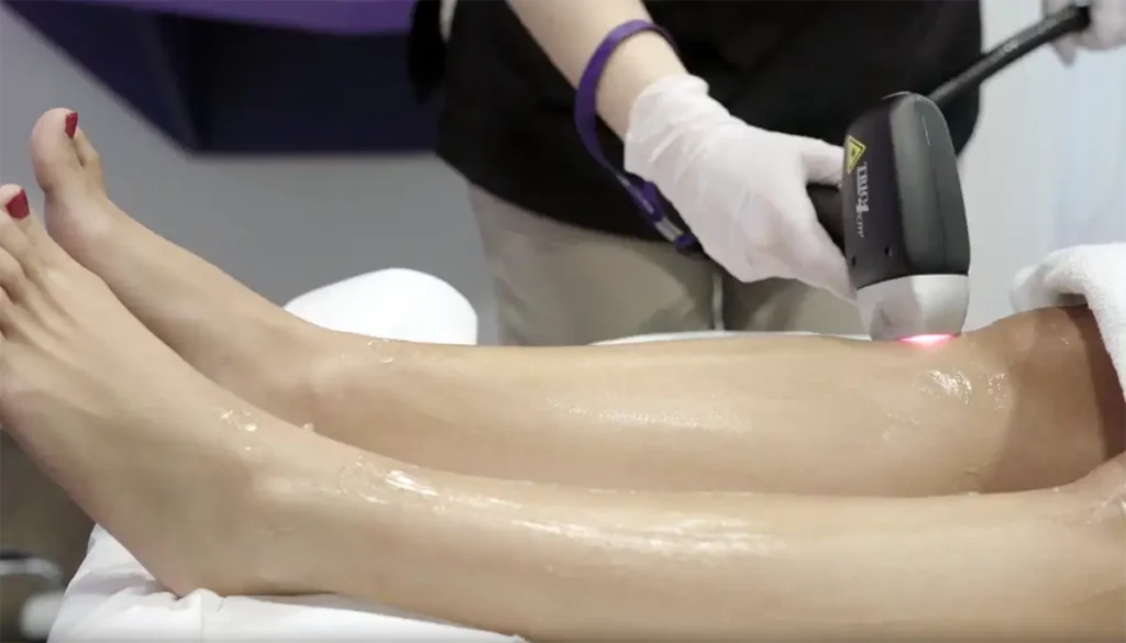 Praticienne réalisant une séance d'épilation laser sur les jambes d'une patiente à la Clinique de la Peau à Nice.