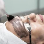 Application du masque de carbone au pinceau sur le visage d'une patiente avant une séance de laser Hollywood Peel à Nice.