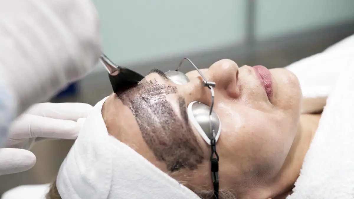 Application du masque de carbone au pinceau sur le visage d'une patiente avant une séance de laser Hollywood Peel à Nice.