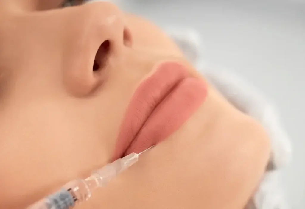 Injection d'acide hyaluronique dans les lèvres pour repulper et hydrater à la Clinique de la Peau à Nice.
