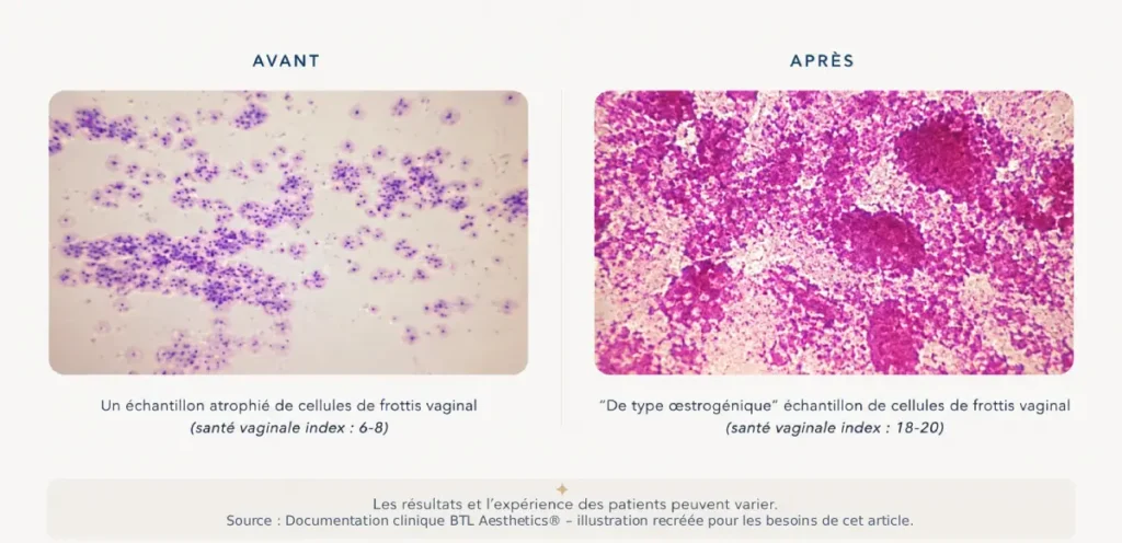Résultat avant après sur frottis cellulaire vaginal montrant l'efficacité du traitement Emfemme 360 contre l'atrophie à Nice