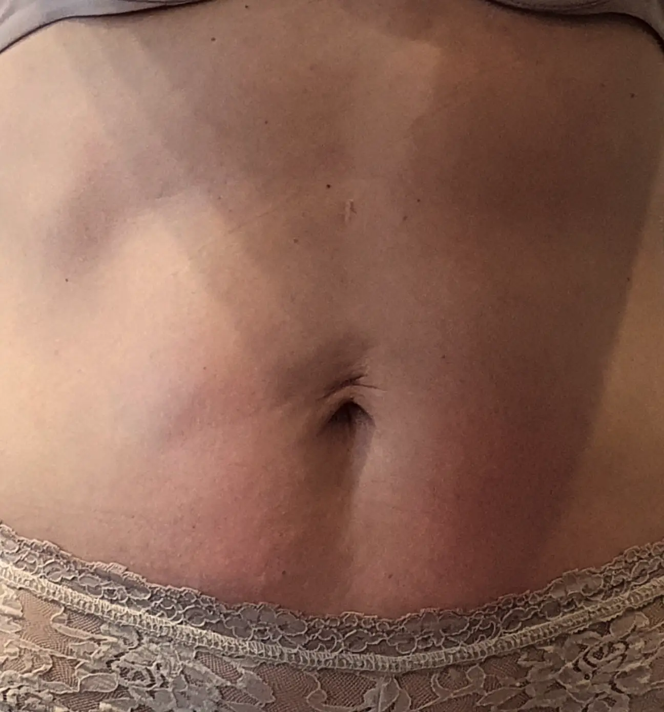 Photo après traitement de la cellulite sur le ventre à Nice.