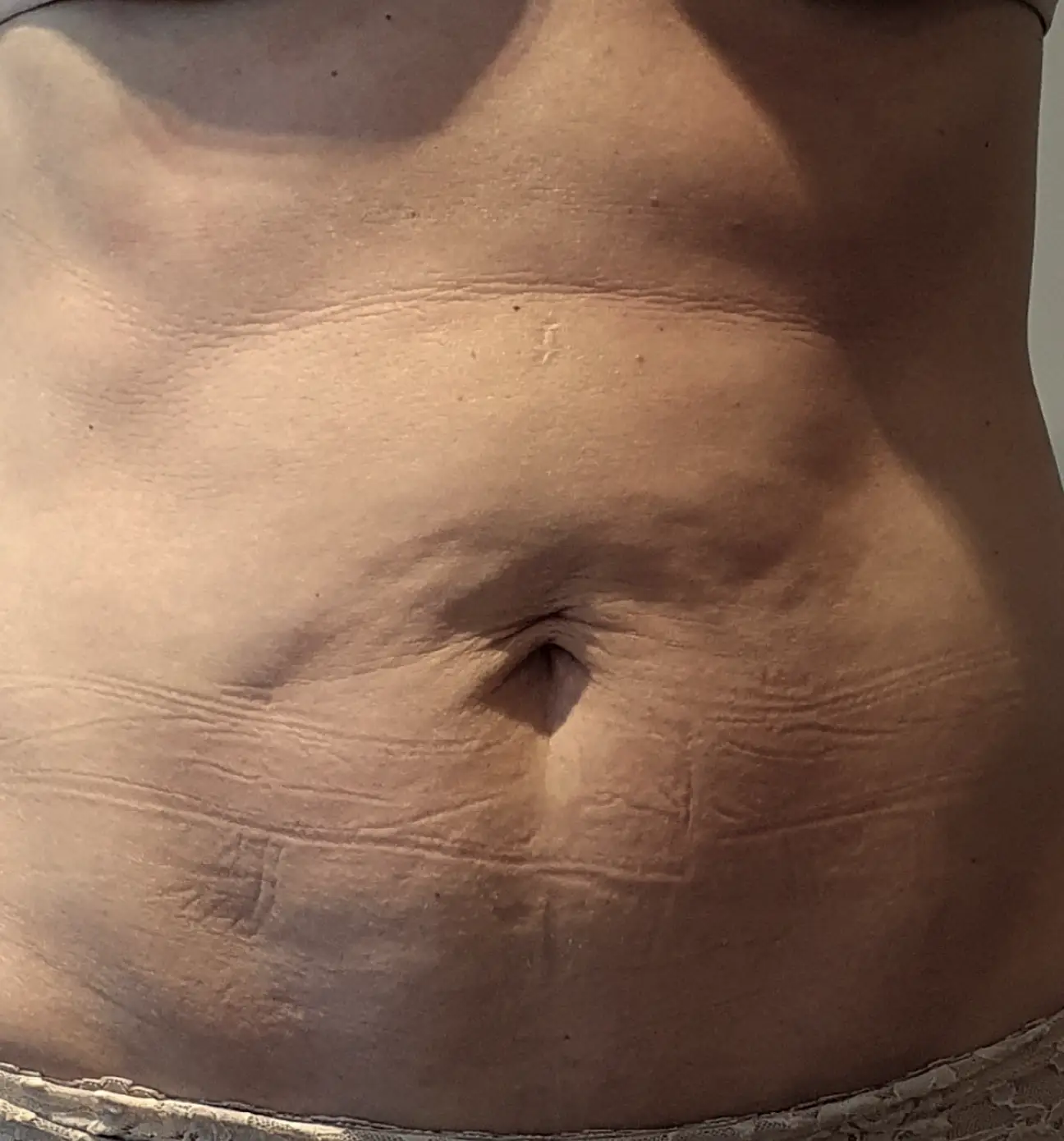 Photo avant traitement de la cellulite sur le ventre à Nice.