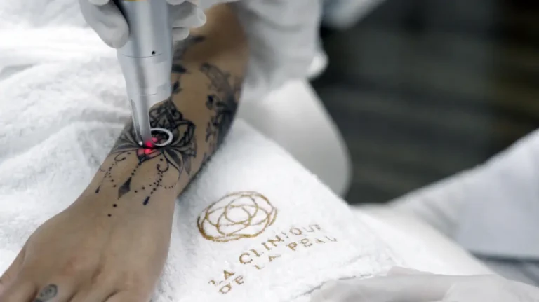 Séance de détatouage laser Picoseconde sur un tatouage au poignet au centre laser Nice de La Clinique de la Peau.