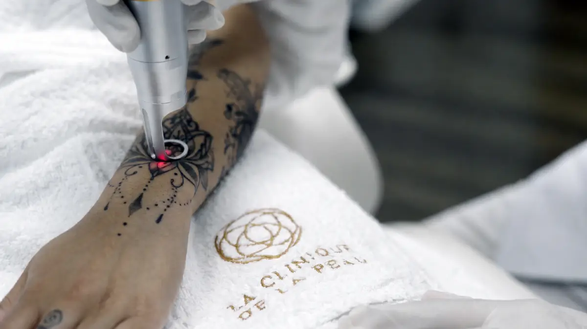 Séance de détatouage laser Picoseconde sur un tatouage au poignet au centre laser Nice de La Clinique de la Peau.