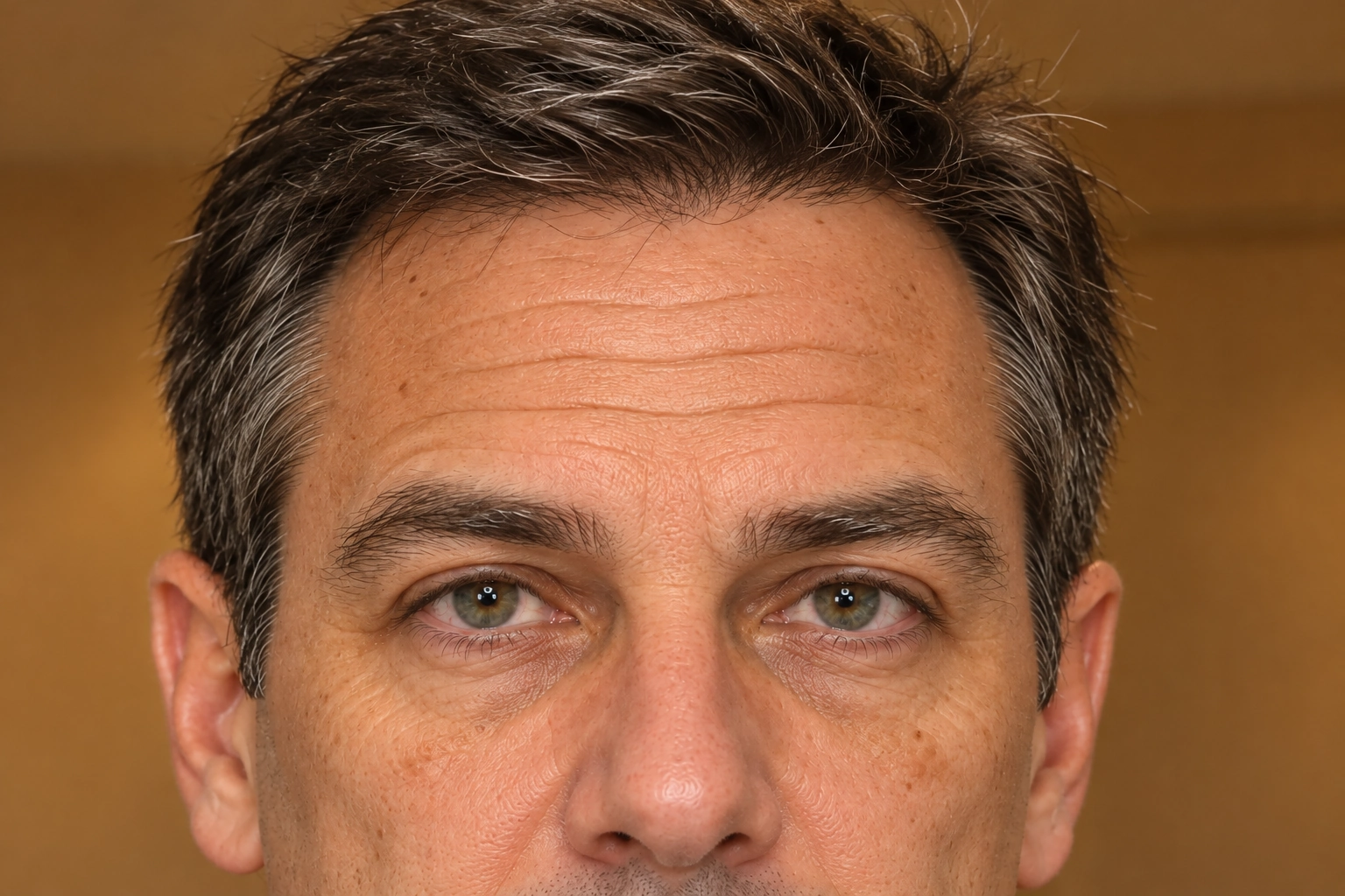 Illustration de rides horizontales du front chez un homme avant un traitement par Botox.
