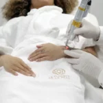 Détatouage au laser d’un tatouage sur l’avant-bras à La Clinique de la Peau à Nice