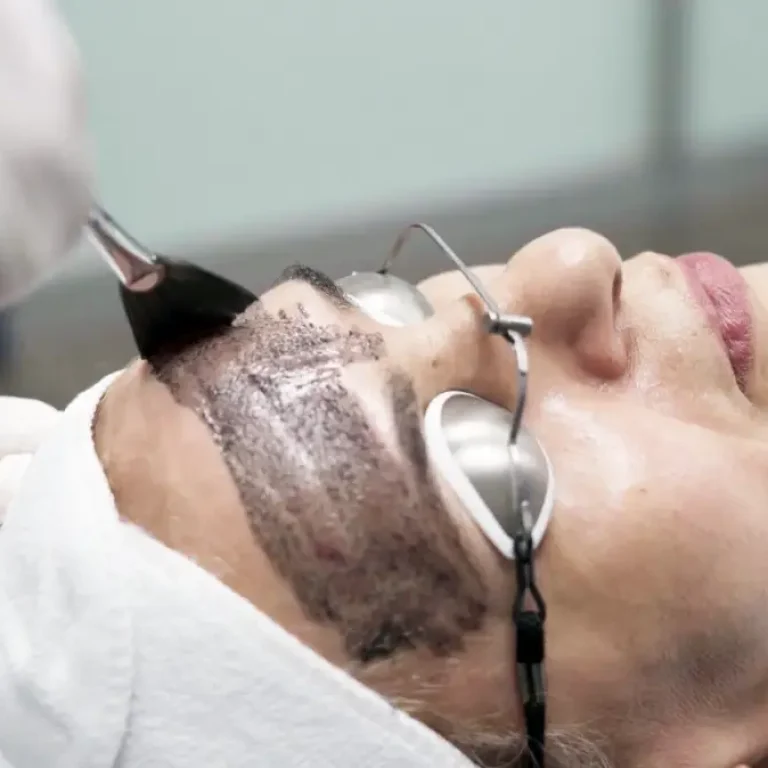 Application du masque de carbone au pinceau sur le visage d'une patiente avant une séance de laser Hollywood Peel à Nice.