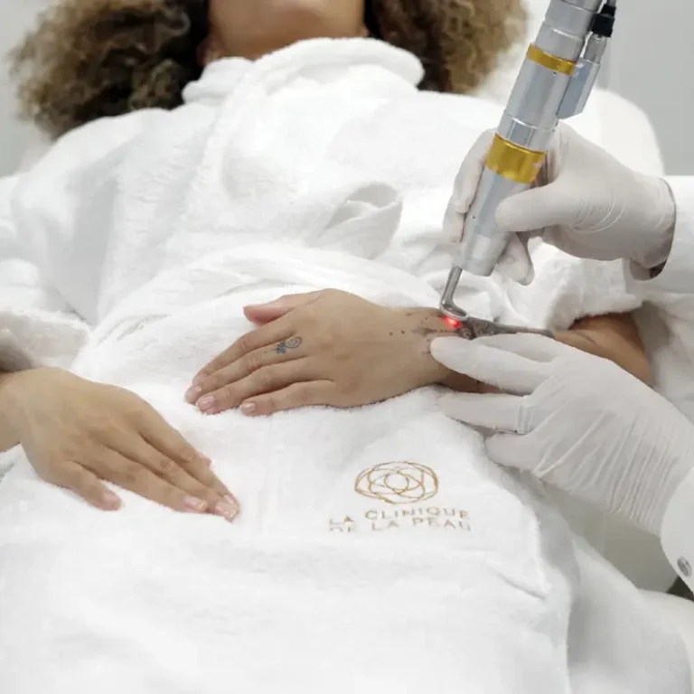 Détatouage au laser d’un tatouage sur l’avant-bras à La Clinique de la Peau à Nice